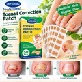 👣Toenail Correction Strips – A Solution for Ingrown Toenails