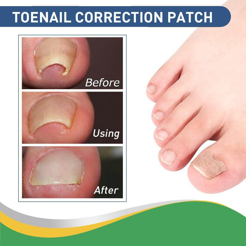👣Toenail Correction Strips – A Solution for Ingrown Toenails