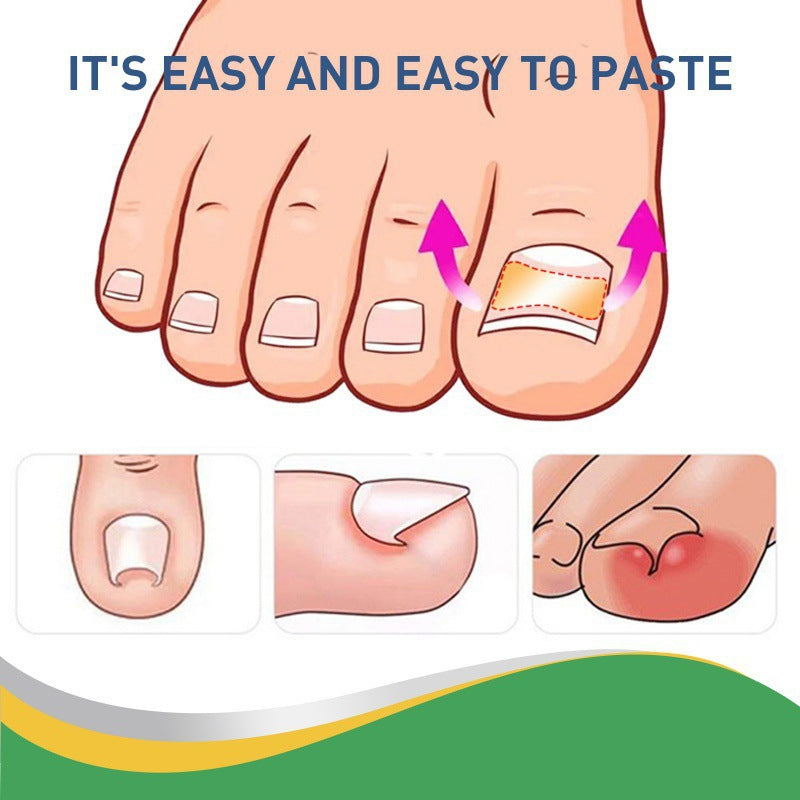👣Toenail Correction Strips – A Solution for Ingrown Toenails